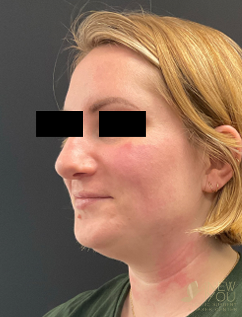 Liposuction Before Liposuction Before - Chicago, IL