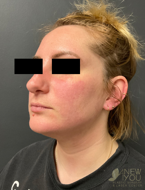 Liposuction After Liposuction After - Chicago, IL
