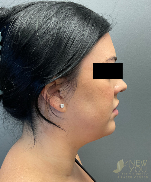 Liposuction Before Liposuction Before - Chicago, IL