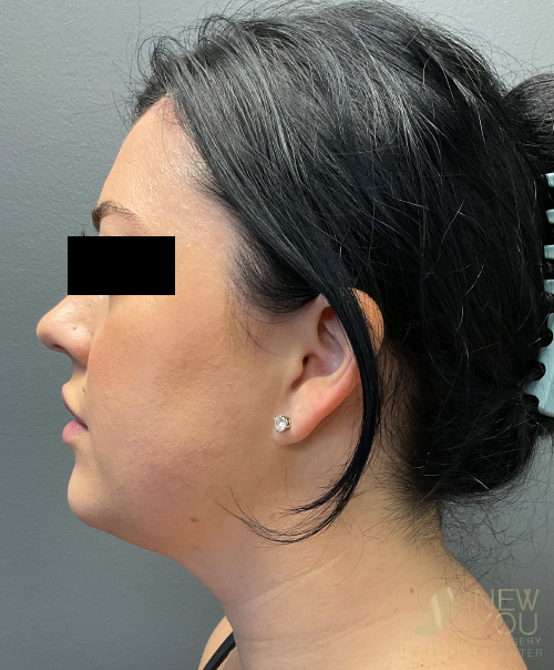 Liposuction Before Liposuction Before - Chicago, IL