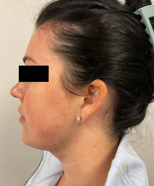 Liposuction After Liposuction After - Chicago, IL