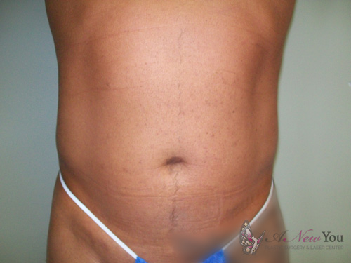 Male Liposuction Before - Chicago, IL