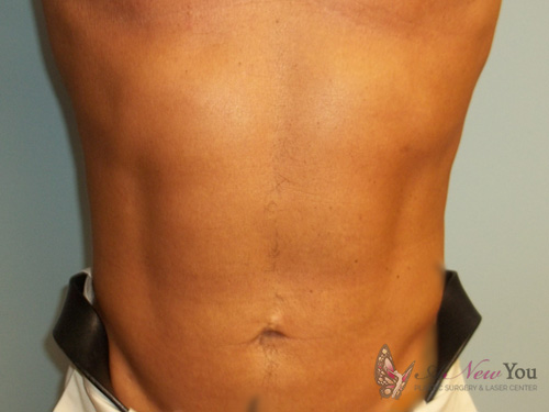 Male Liposuction After - Chicago, IL