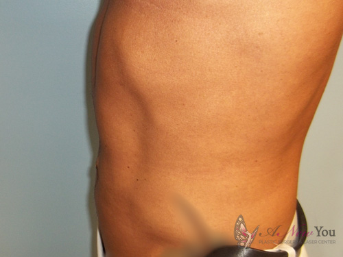 Male Liposuction After - Chicago, IL