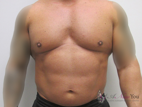 Male Liposuction Before - Chicago, IL
