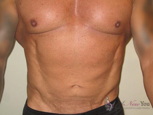 Male Liposuction After - Chicago, IL
