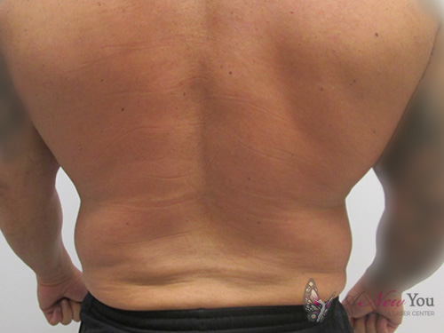 Male Liposuction Before - Chicago, IL