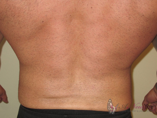 Male Liposuction After - Chicago, IL