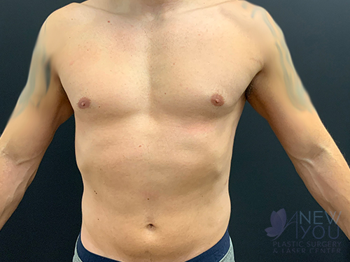 Male Liposuction Before Male Liposuction Before - Chicago, IL