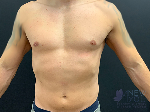 Male Liposuction Before - Chicago, IL