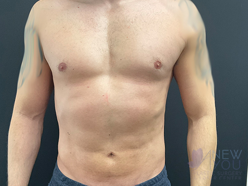 Male Liposuction After - Chicago, IL