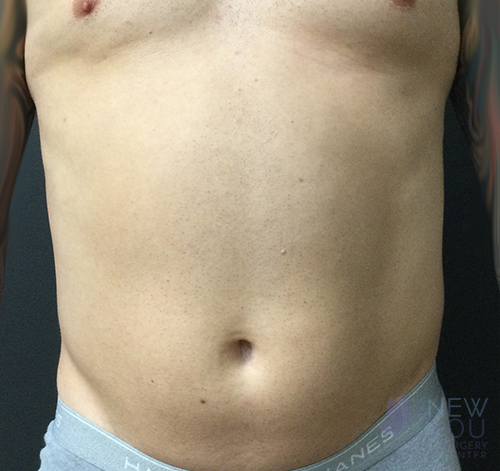 Male Liposuction Before - Chicago, IL