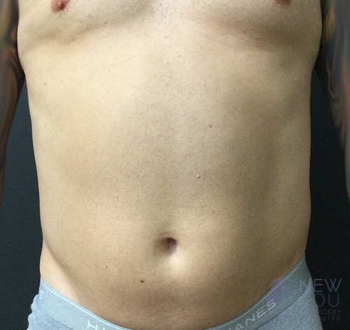 Male Liposuction Before Male Liposuction Before - Chicago, IL