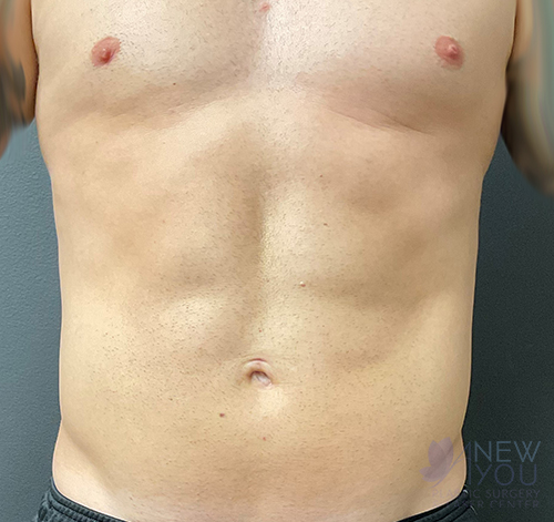 Male Liposuction After - Chicago, IL