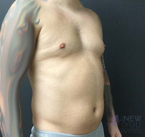 Male Liposuction Before - Chicago, IL