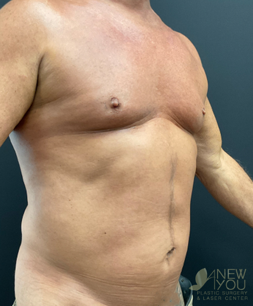 Male Liposuction Before Male Liposuction Before - Chicago, IL