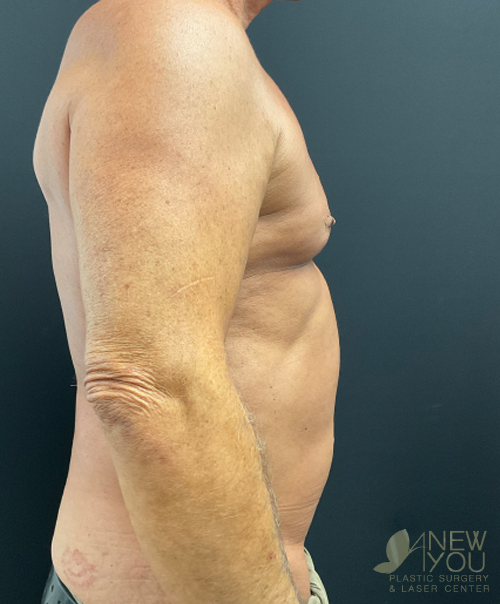 Male Liposuction Before Male Liposuction Before - Chicago, IL