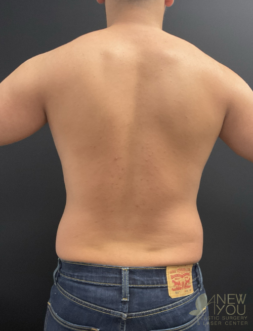 Male Liposuction Before - Chicago, IL