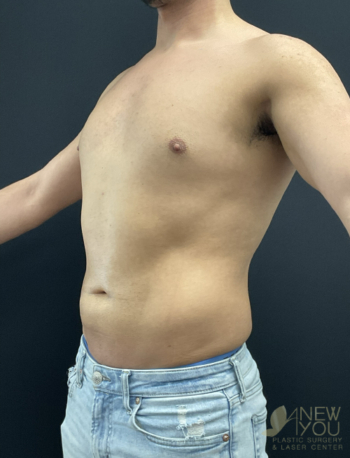 Male Liposuction After - Chicago, IL