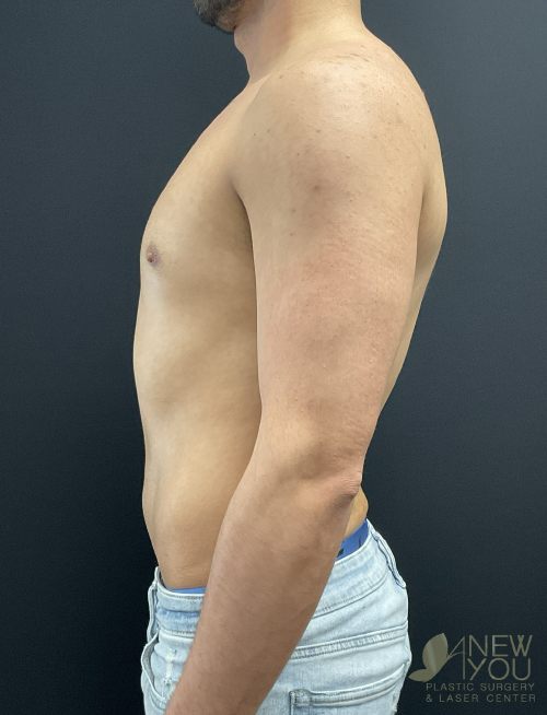 Male Liposuction After - Chicago, IL