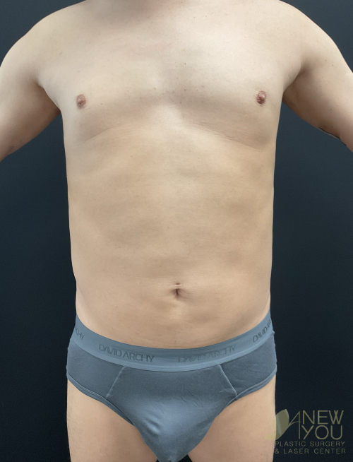 Male Liposuction Before Male Liposuction Before - Chicago, IL