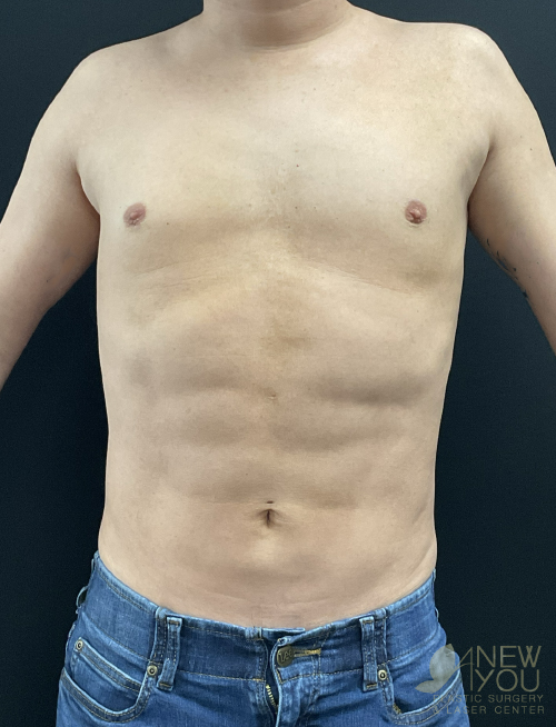 Male Liposuction After Male Liposuction After - Chicago, IL