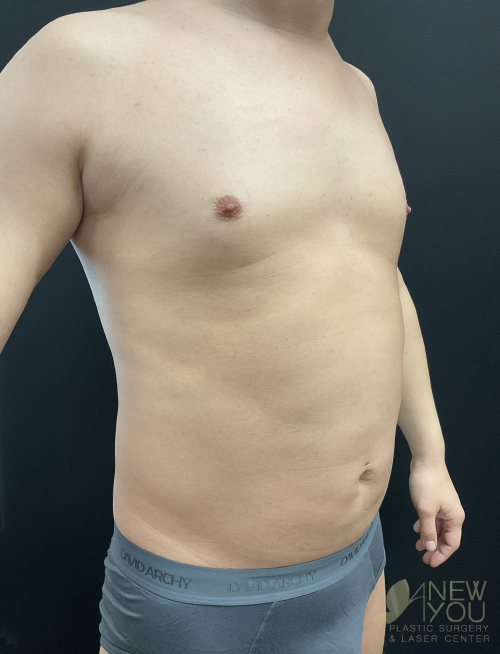 Male Liposuction Before Male Liposuction Before - Chicago, IL