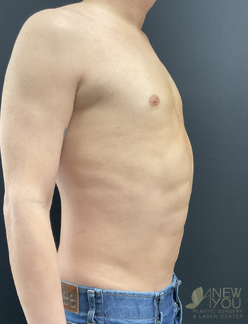 Male Liposuction After Male Liposuction After - Chicago, IL