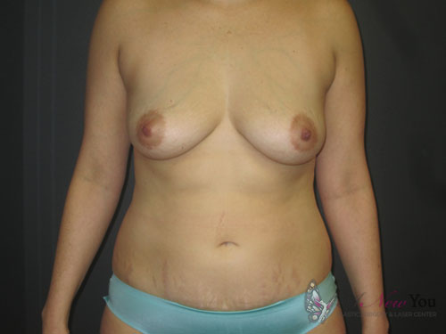 Mommy Makeover Before Mommy Makeover Before - Chicago, IL