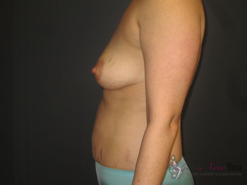 Mommy Makeover Before Mommy Makeover Before - Chicago, IL