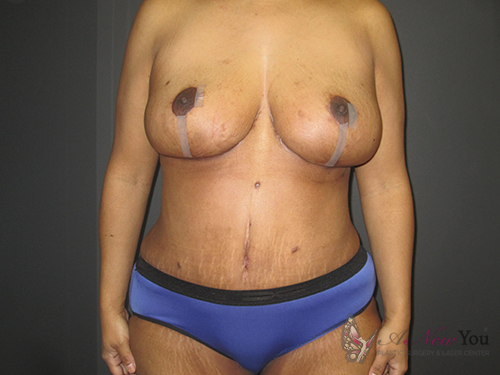 Mommy Makeover After Mommy Makeover After - Chicago, IL
