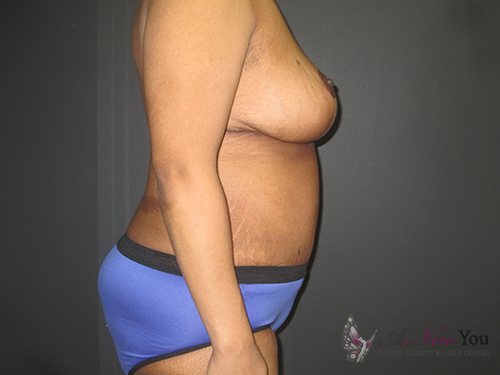 Mommy Makeover After Mommy Makeover After - Chicago, IL