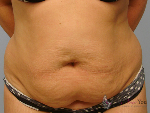 Tummy Tuck Before - Chicago, IL