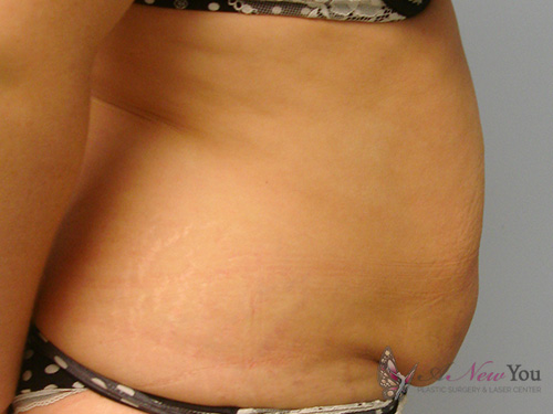 Tummy Tuck Before Tummy Tuck Before - Chicago, IL