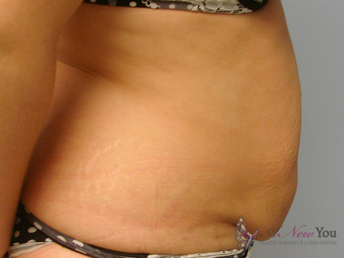 Tummy Tuck Before - Chicago, IL