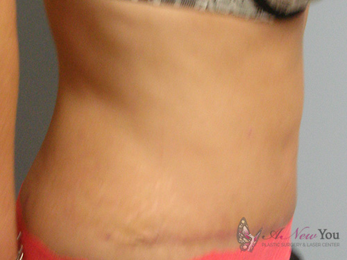 Tummy Tuck After - Chicago, IL