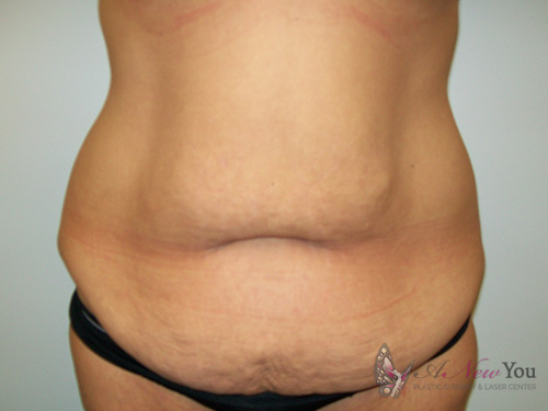 Tummy Tuck Before - Chicago, IL