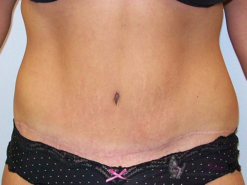 Tummy Tuck After - Chicago, IL