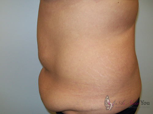 Tummy Tuck Before - Chicago, IL