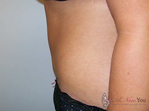 Tummy Tuck After - Chicago, IL