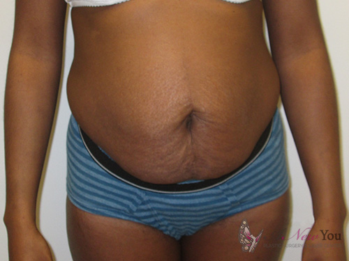 Tummy Tuck Before - Chicago, IL