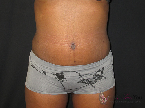 Tummy Tuck After - Chicago, IL