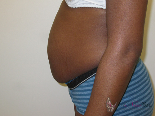 Tummy Tuck Before Tummy Tuck Before - Chicago, IL