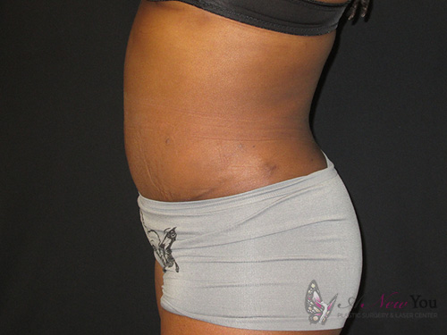 Tummy Tuck After - Chicago, IL