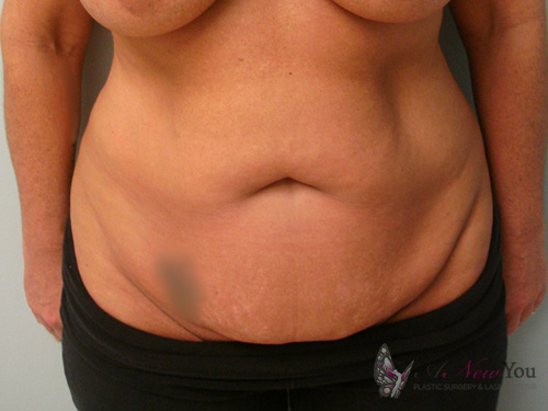 Tummy Tuck Before - Chicago, IL