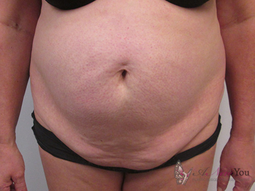 Tummy Tuck Before - Chicago, IL