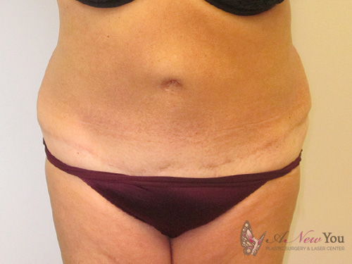 Tummy Tuck After - Chicago, IL