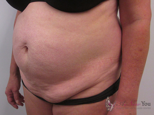 Tummy Tuck Before - Chicago, IL