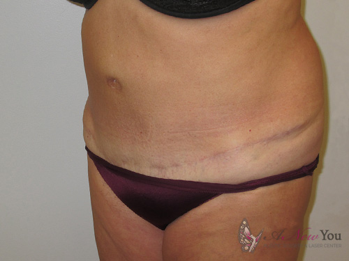 Tummy Tuck After - Chicago, IL