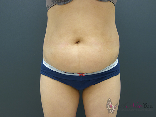 Tummy Tuck Before - Chicago, IL